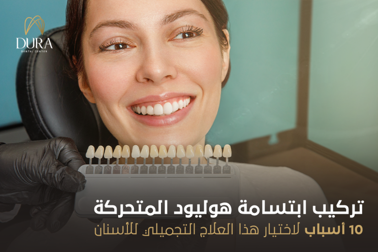 تركيب ابتسامة هوليود المتحركة