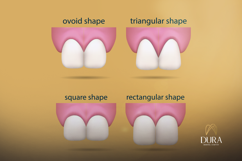 أنواع فينير الأسنان