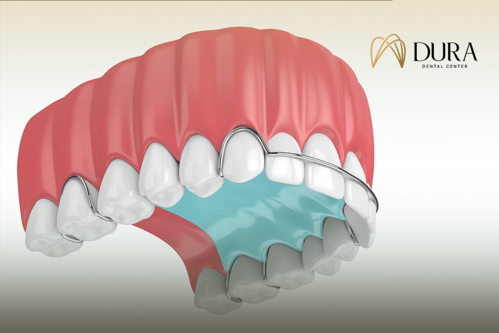 تقويم الاسنان المتحرك للكبار