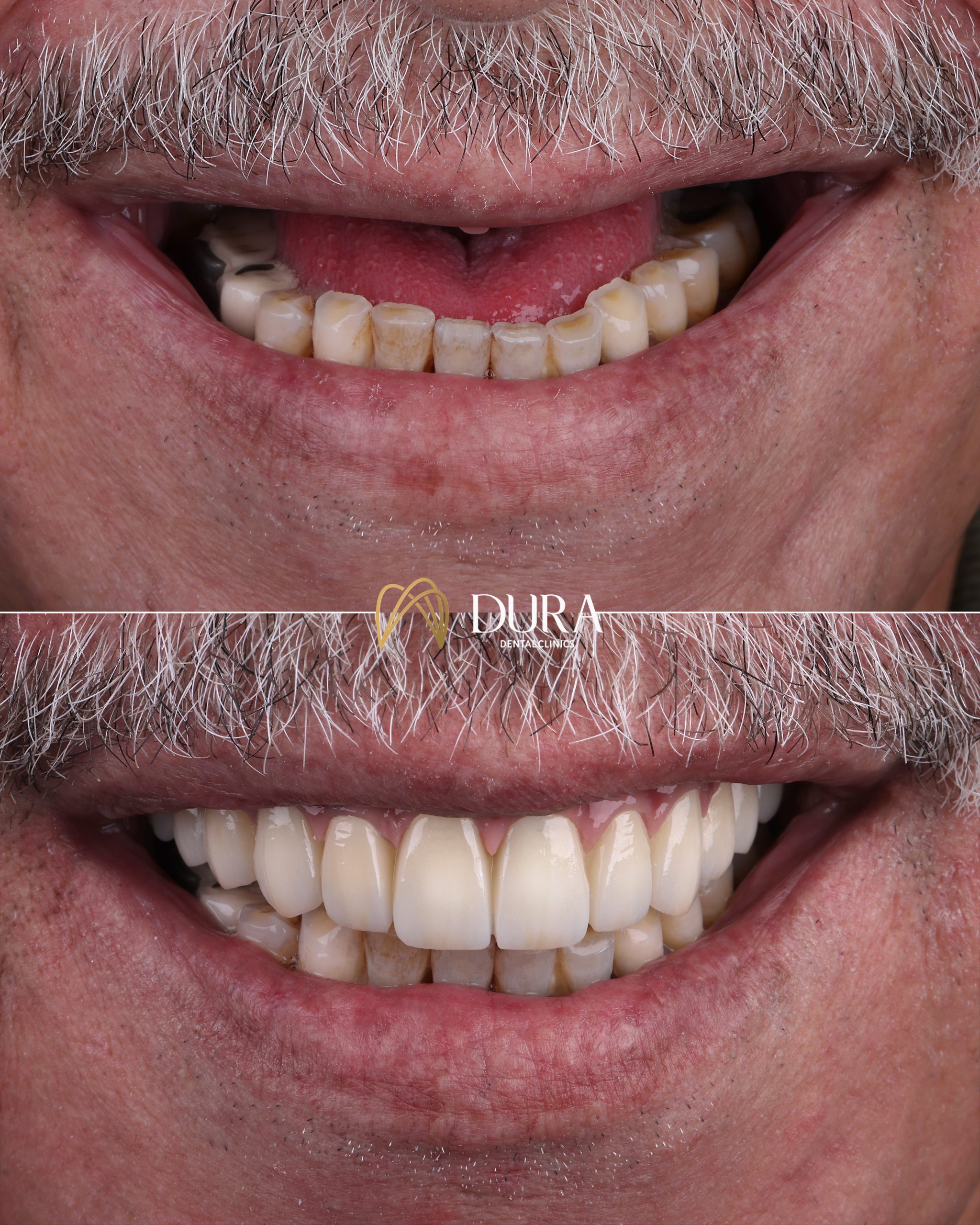 Dura Template B&A new (1)