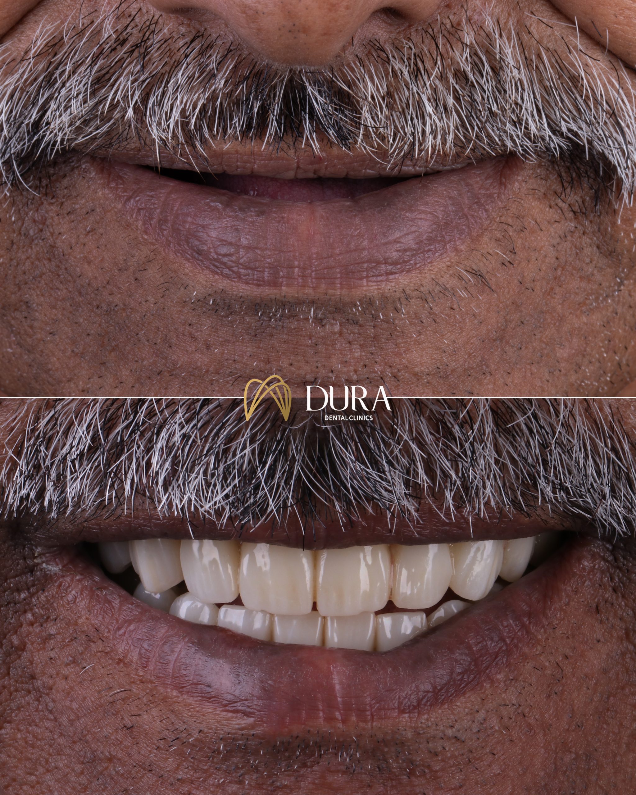 Dura Template B&A new