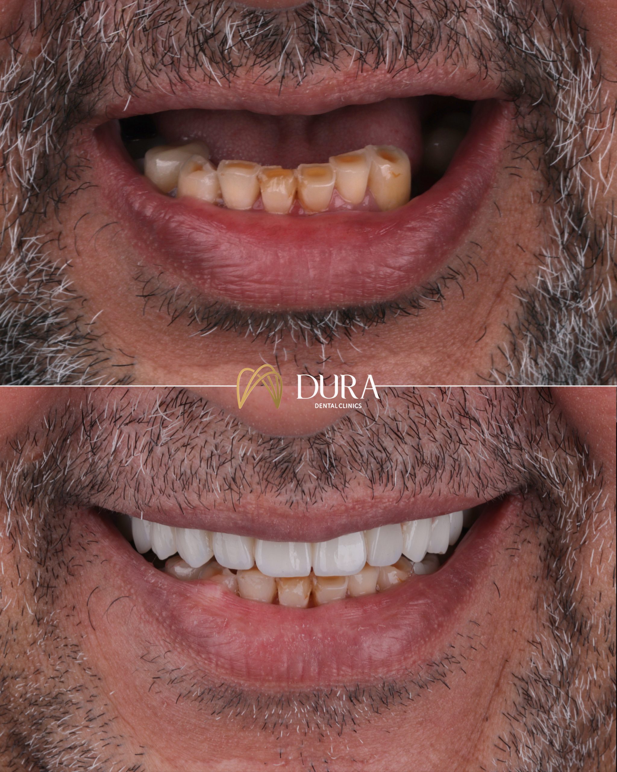 Dura3 Template B&A new