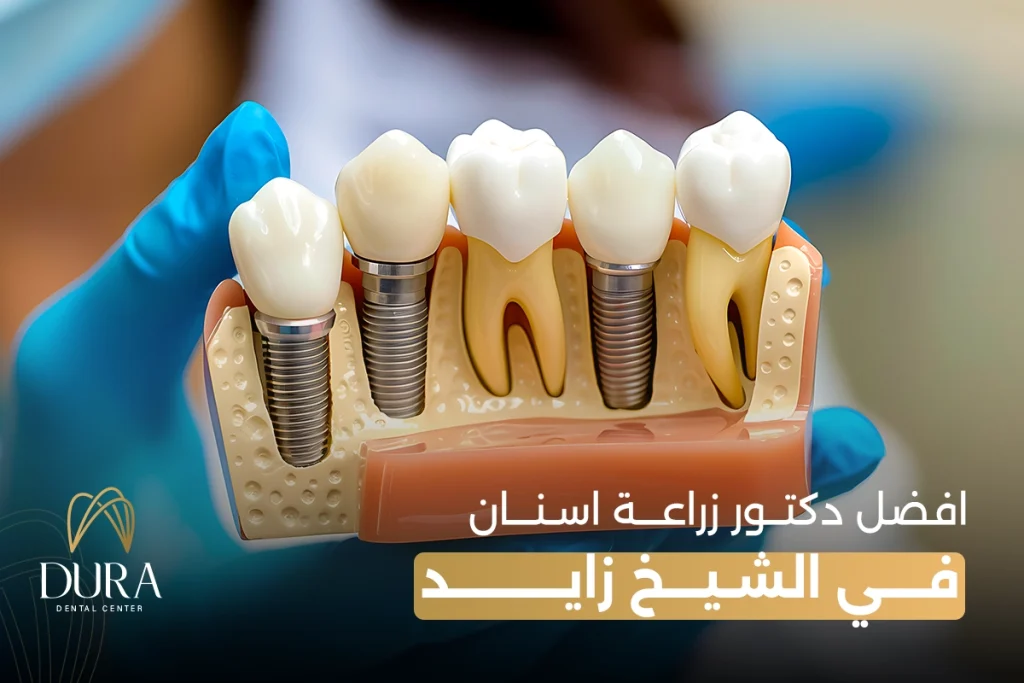 أفضل دكتور زراعة اسنان في الشيخ زايد